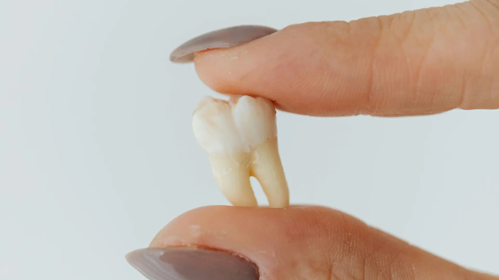 Close-up of a removed wisdom tooth